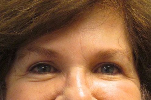 after blepharoplasty