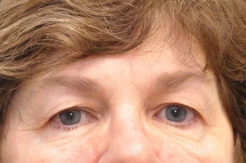 before blepharoplasty