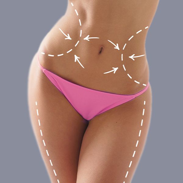 Surgical lines on woman's midsection