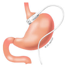 Gastric Banding
