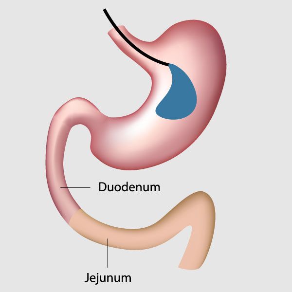 Gastric Balloon Surgery
