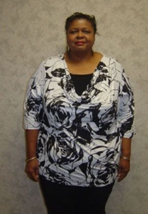 Dr. Matthew St. Laurent's patient before gastric bypass