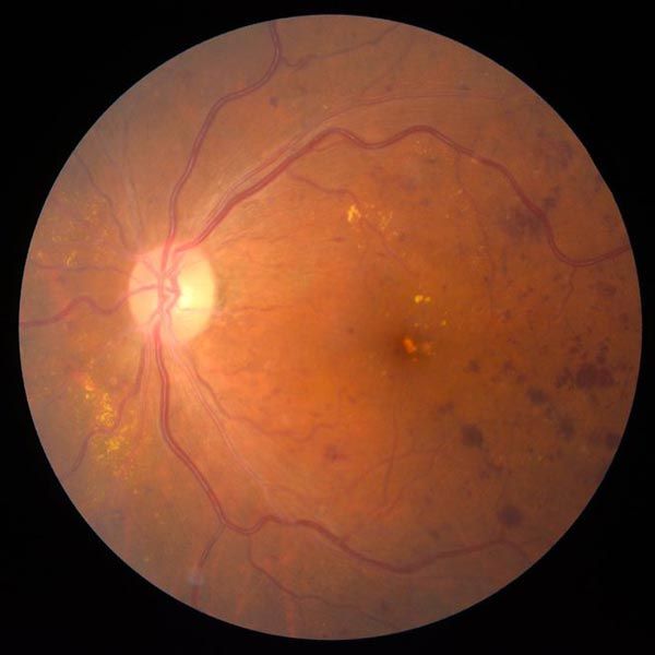 Diabetic retinopathy