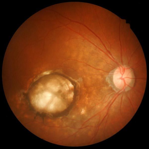 Closeup of retina affected by macular degeneration