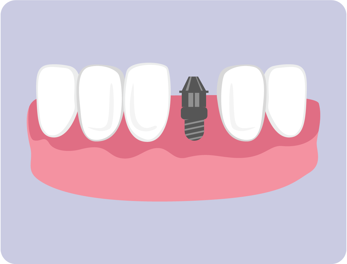 Cost of Dental Implants Brooklyn, NY Brooklyn Heights, NY Dentistry