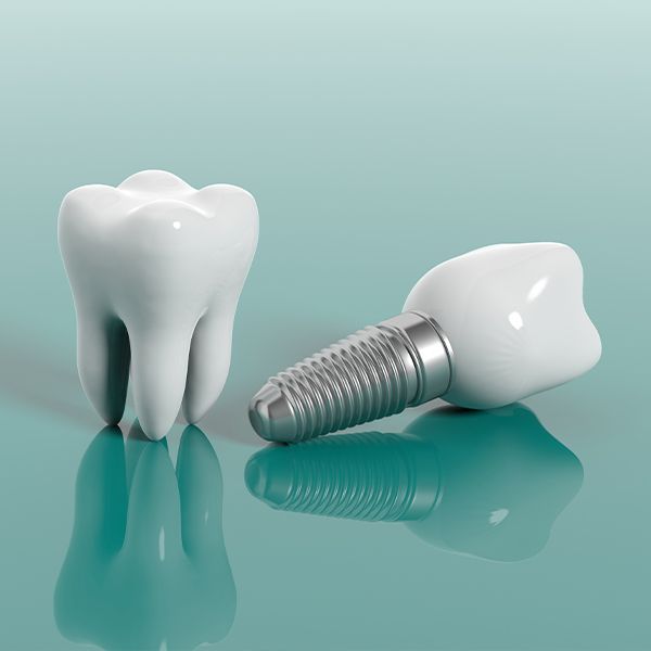 Dental implants