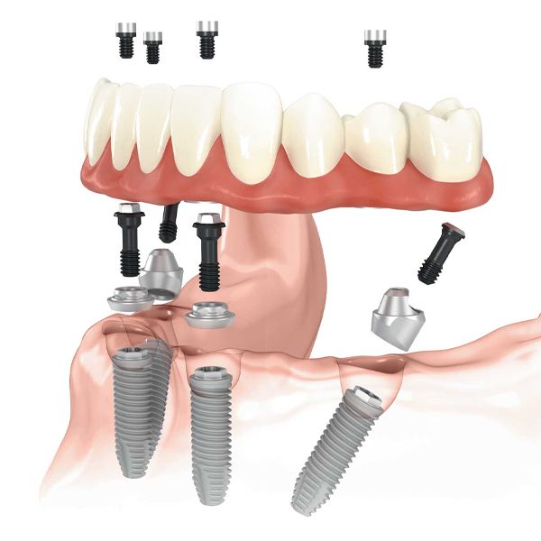 All-on-4 implants
