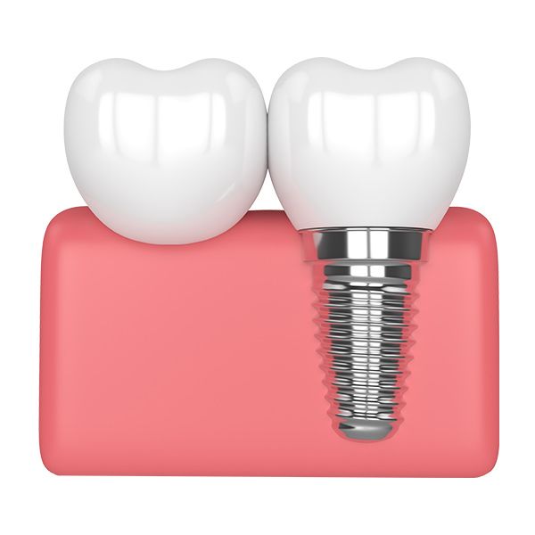 Dental Implants