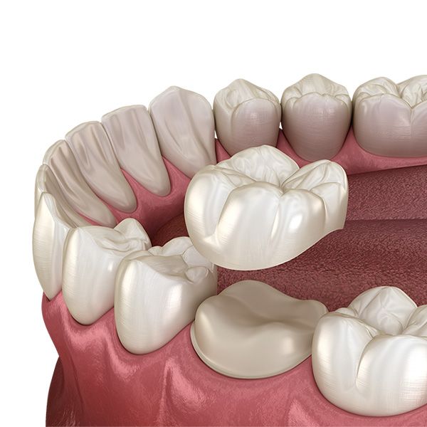 Dental Crowns