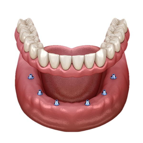 Implant-Supported Dentures