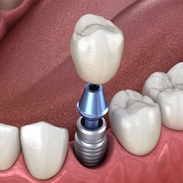 Dental Implants