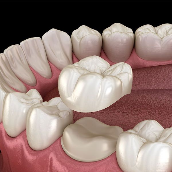 Dental Crowns