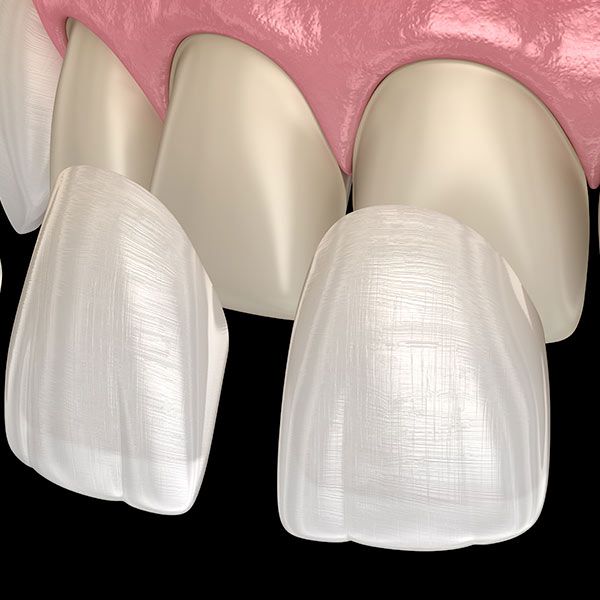 Porcelain Veneers