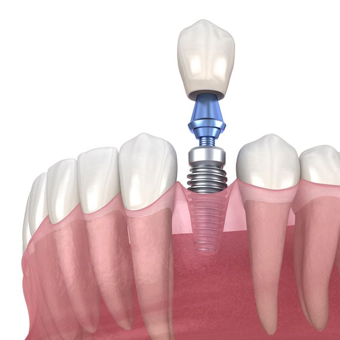 Dental implants