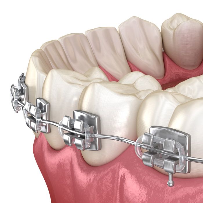 a diagram of traditional braces
