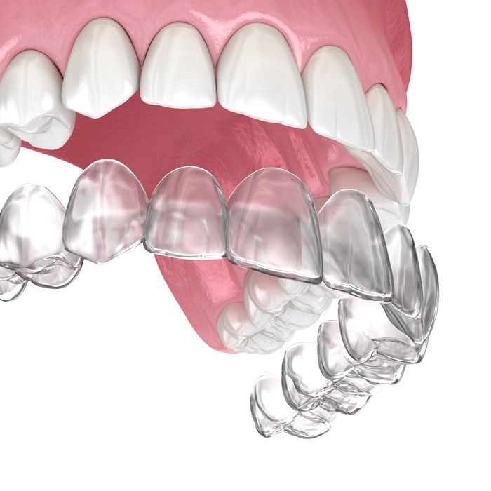 An illustration of an Invisalign aligner tray over teeth.