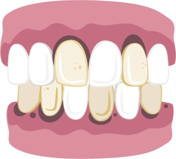 Smile with discolored teeth