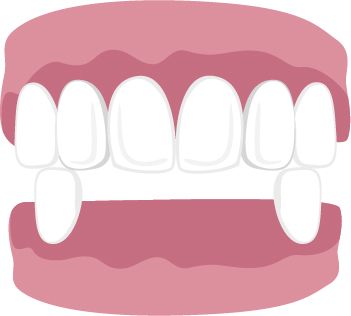 Smile with four front teeth missing