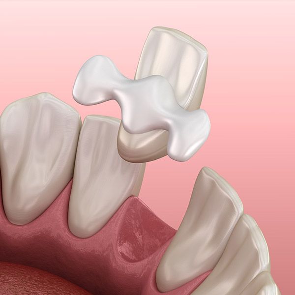 Maryland Bonded Dental Bridge