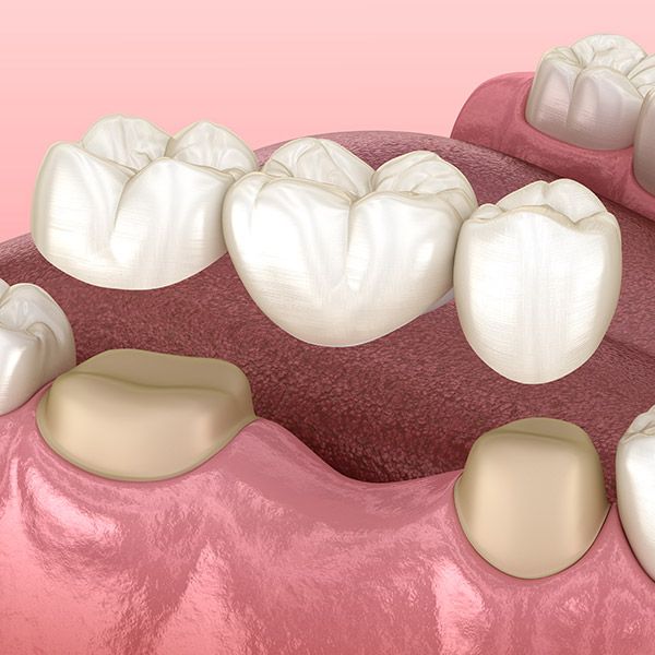 Traditional Dental Bridge