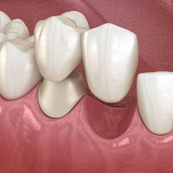 Cantilever Dental Bridge