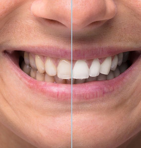 Explore Teeth Whitening
