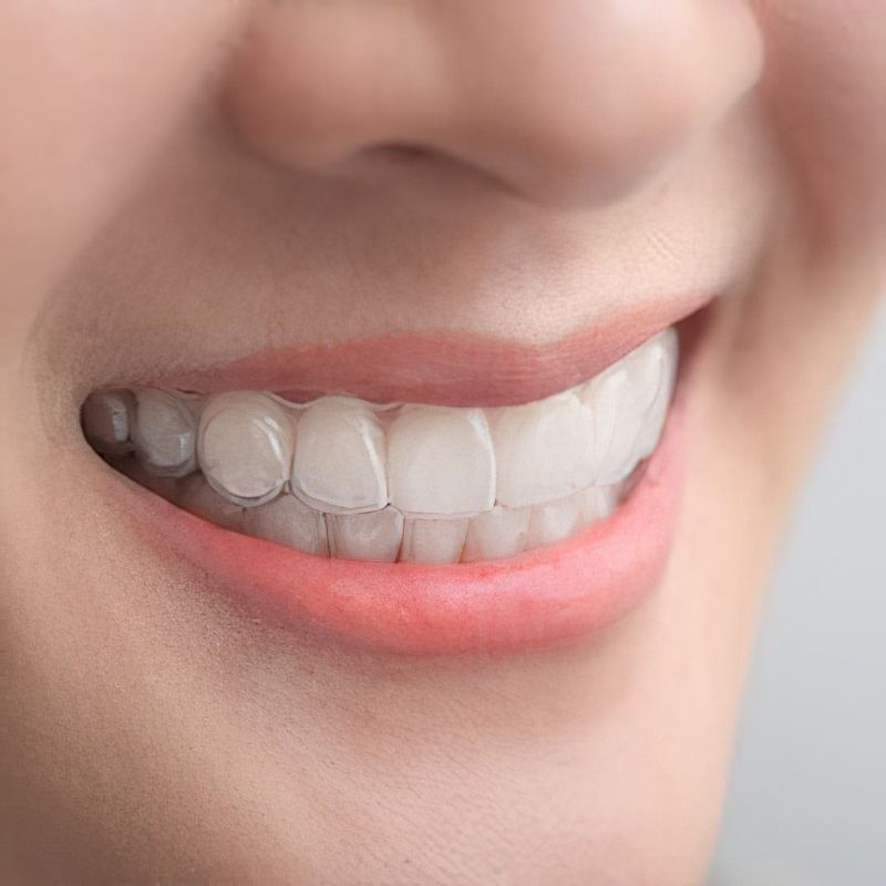 Invisalign®