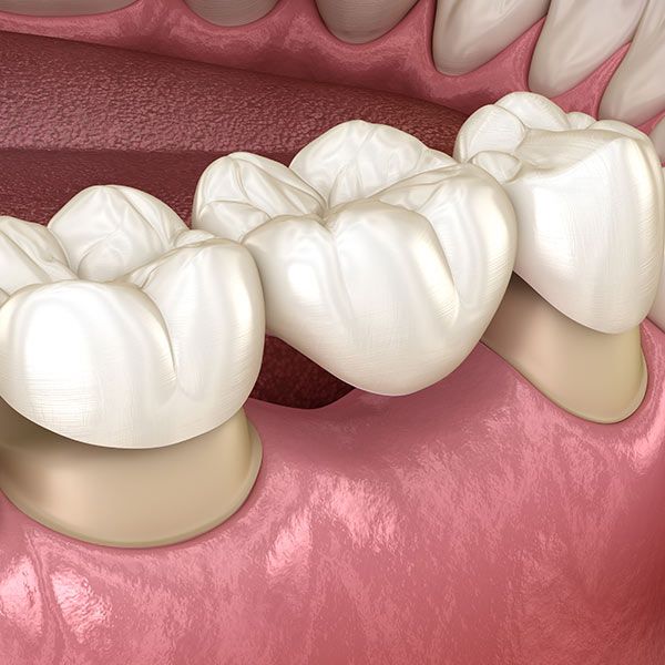 Traditional Dental Bridge