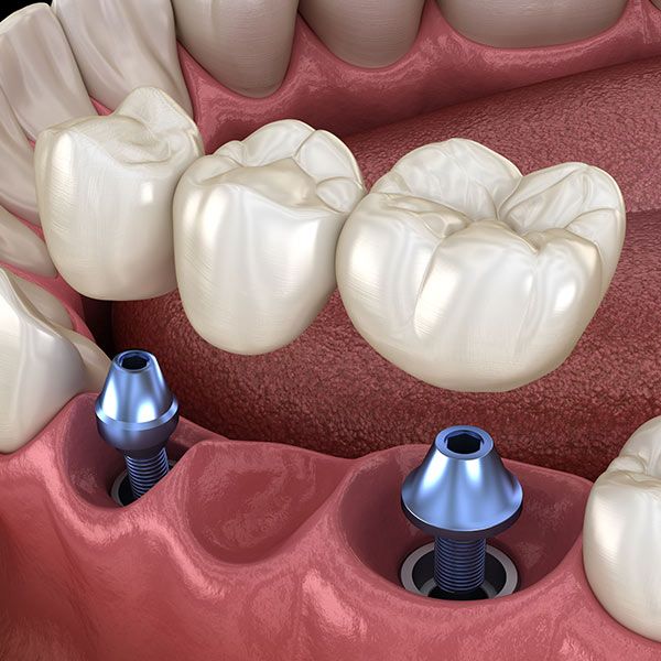Implant-Supported Bridge