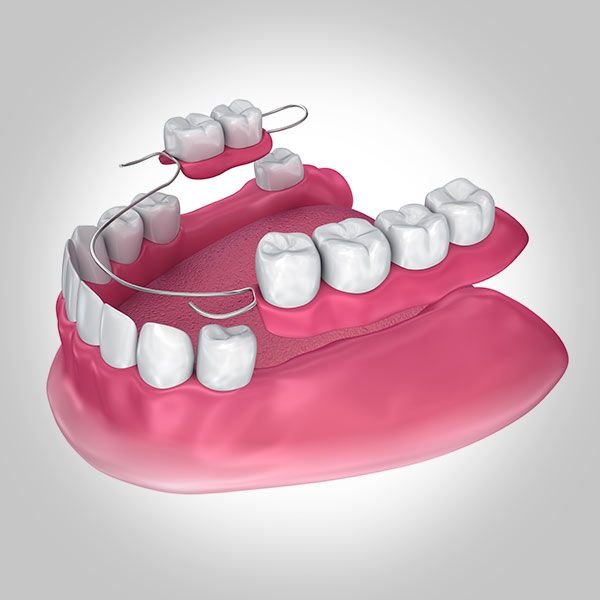 Partial Dentures