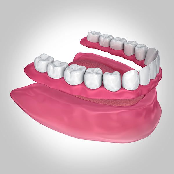 Traditional Dentures