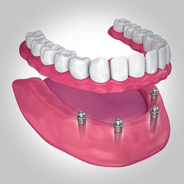Implant-Supported Dentures