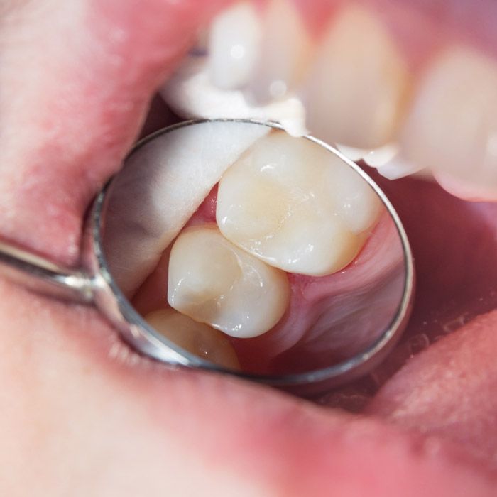 dental mirror reflecting teeth