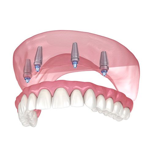All-on-4® implants