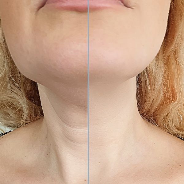 Before and after neck lift