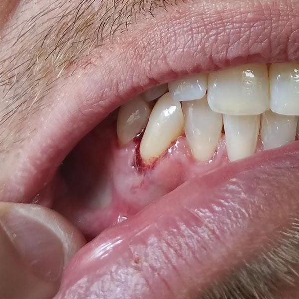 Bleeding gums