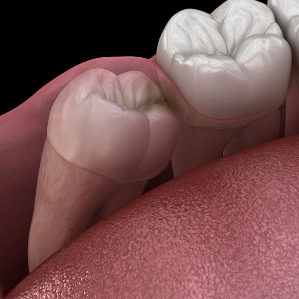 illustration showing impacted wisdom tooth