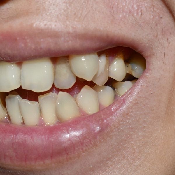 close-up of impacted canines