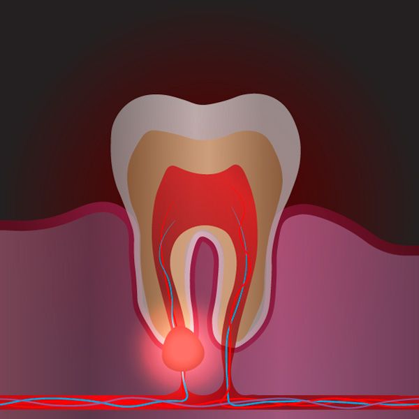 illustration of an infection in the tooth root