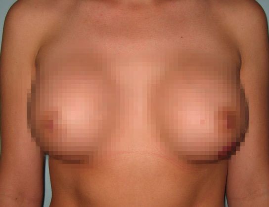 Larger, fuller breasts