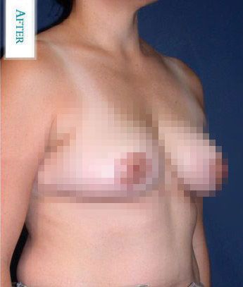 After Breast Lift