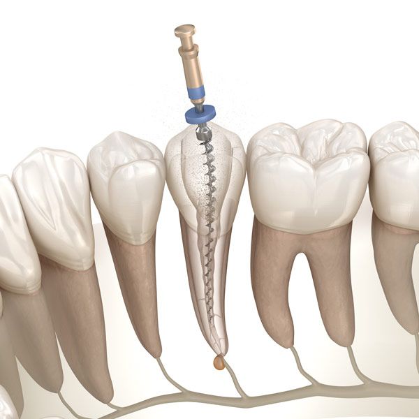 Root canal therapy