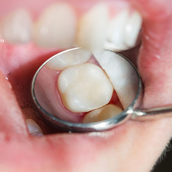Molar with a white dental filling