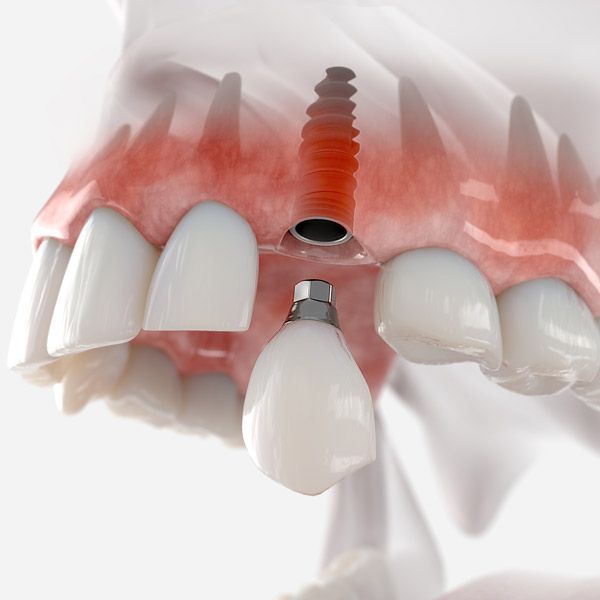 Dental implant for single-tooth replacement