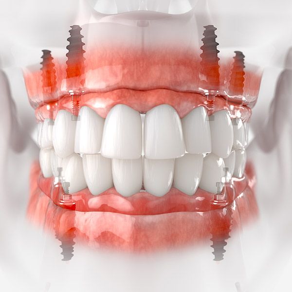 Dentures supported by All-on-4 dental implants