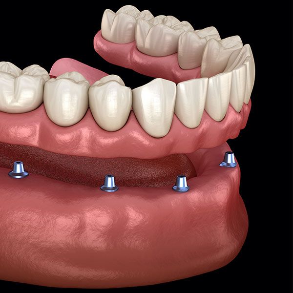 Dental Implants
