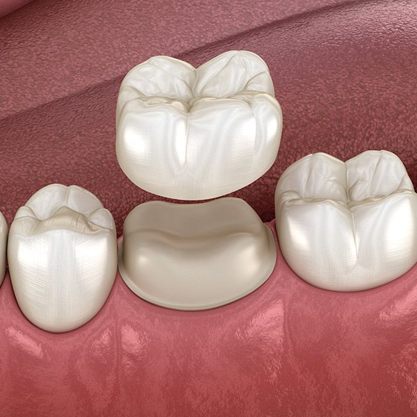 Dental Crowns