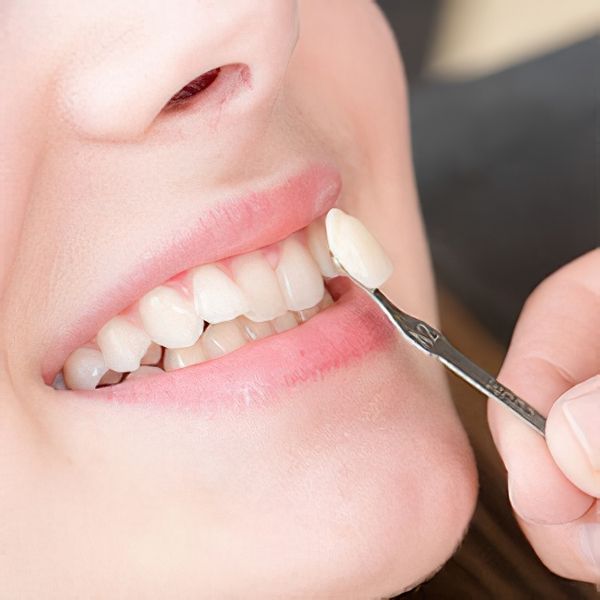 Dental veneer next to woman's tooth
