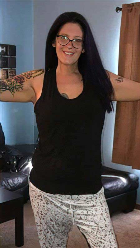 slim patient after bariatric surgery