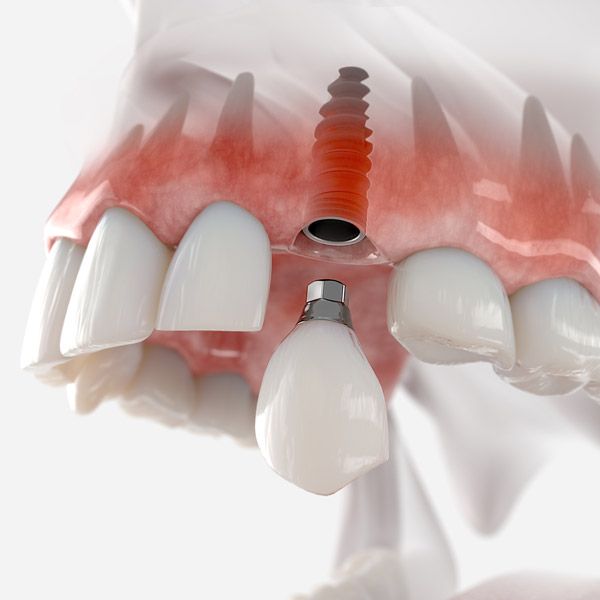 Implant in model of jaw